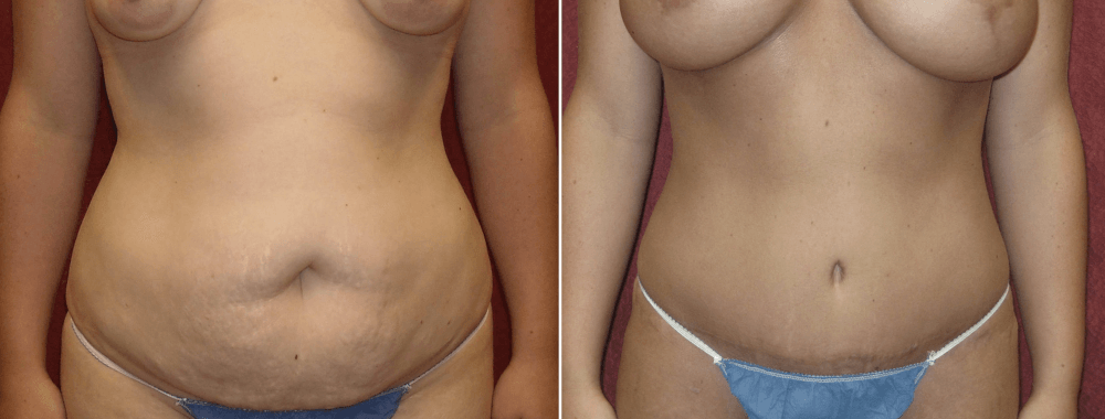 Tummy Tuck Before and After Ph